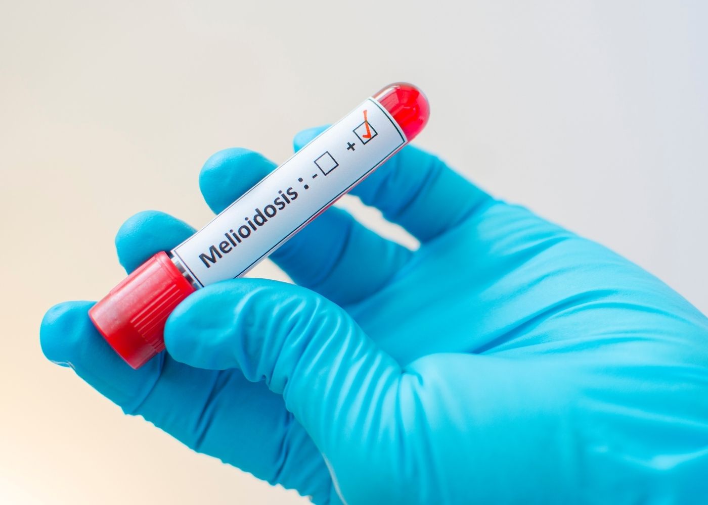 Melioidosis Information Hand wearing a blue surgical glove holiding a vial labelled Melioidosis